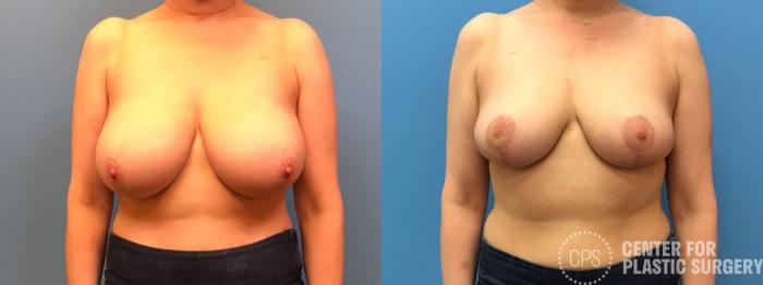 Breast Reduction Case 242 Before & After Front | Chevy Chase & Annandale, Washington D.C. Metropolitan Area | Center for Plastic Surgery