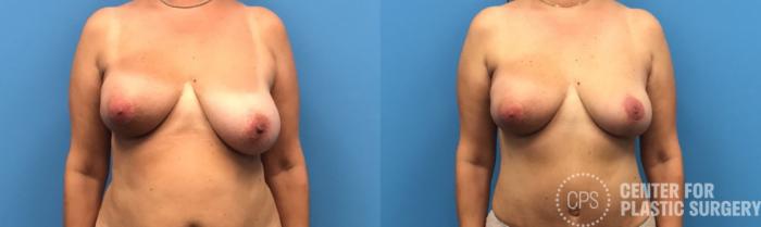 Breast Reduction Case 316 Before & After Front | Chevy Chase & Annandale, Washington D.C. Metropolitan Area | Center for Plastic Surgery