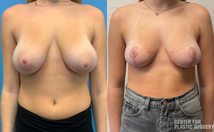 Breast Reduction Case 323 Before & After Front | Chevy Chase & Annandale, Washington D.C. Metropolitan Area | Center for Plastic Surgery
