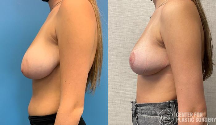 Breast Reduction Case 323 Before & After Left Side | Chevy Chase & Annandale, Washington D.C. Metropolitan Area | Center for Plastic Surgery
