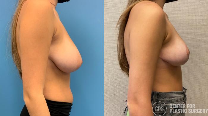 Breast Reduction Case 323 Before & After Right Side | Chevy Chase & Annandale, Washington D.C. Metropolitan Area | Center for Plastic Surgery