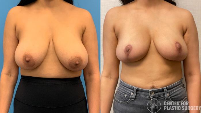 Breast Reduction Case 324 Before & After Front | Chevy Chase & Annandale, Washington D.C. Metropolitan Area | Center for Plastic Surgery