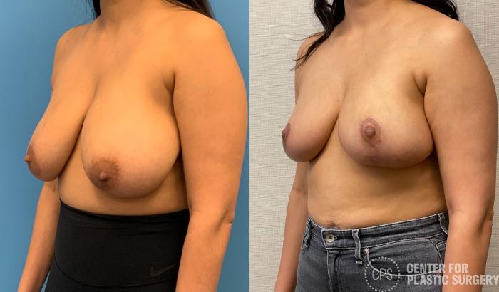 Breast Reduction Case 324 Before & After Left Oblique | Chevy Chase & Annandale, Washington D.C. Metropolitan Area | Center for Plastic Surgery