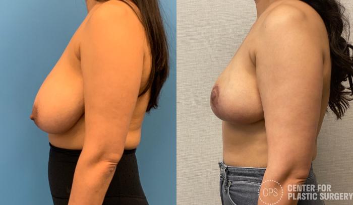 Breast Reduction Case 324 Before & After Left Side | Chevy Chase & Annandale, Washington D.C. Metropolitan Area | Center for Plastic Surgery