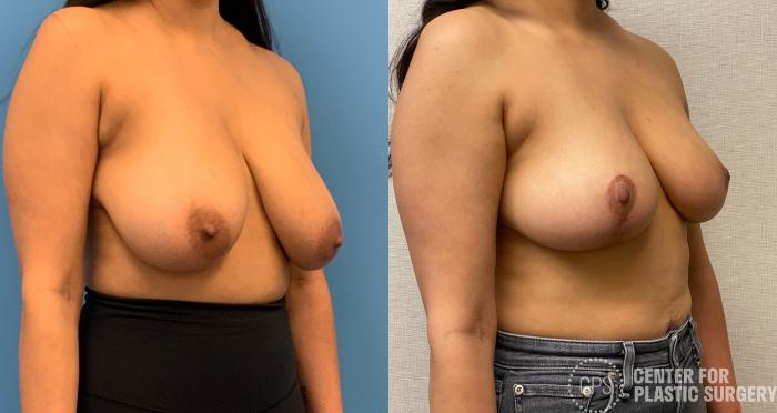 Breast Reduction Case 324 Before & After Right Oblique | Chevy Chase & Annandale, Washington D.C. Metropolitan Area | Center for Plastic Surgery