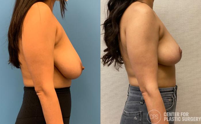 Breast Reduction Case 324 Before & After Right Side | Chevy Chase & Annandale, Washington D.C. Metropolitan Area | Center for Plastic Surgery