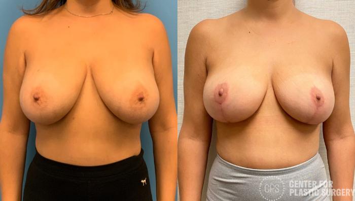 Breast Reduction Case 325 Before & After Front | Chevy Chase & Annandale, Washington D.C. Metropolitan Area | Center for Plastic Surgery
