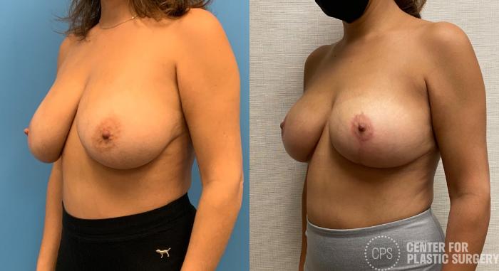 Breast Reduction Case 325 Before & After Left Oblique | Chevy Chase & Annandale, Washington D.C. Metropolitan Area | Center for Plastic Surgery