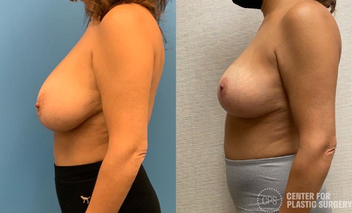 Breast Reduction Case 325 Before & After Left Side | Chevy Chase & Annandale, Washington D.C. Metropolitan Area | Center for Plastic Surgery