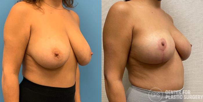 Breast Reduction Case 325 Before & After Right Oblique | Chevy Chase & Annandale, Washington D.C. Metropolitan Area | Center for Plastic Surgery