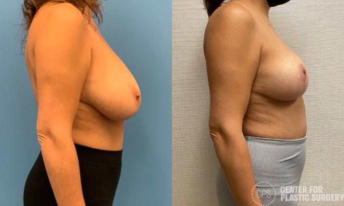 Breast Reduction Case 325 Before & After Right Side | Chevy Chase & Annandale, Washington D.C. Metropolitan Area | Center for Plastic Surgery