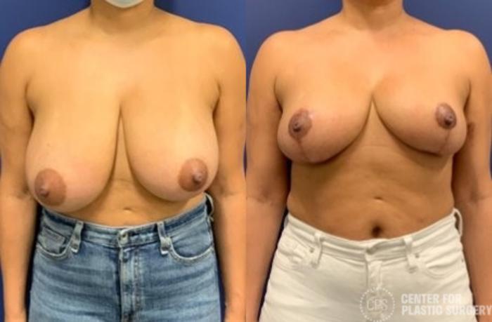 Breast Reduction Case 398 Before & After Front | Chevy Chase & Annandale, Washington D.C. Metropolitan Area | Center for Plastic Surgery