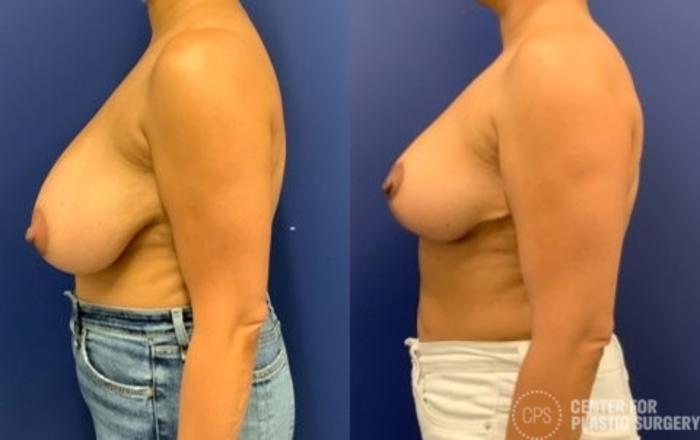 Breast Reduction Case 398 Before & After Left Side | Chevy Chase & Annandale, Washington D.C. Metropolitan Area | Center for Plastic Surgery