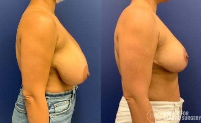 Breast Reduction Case 398 Before & After Right Side | Chevy Chase & Annandale, Washington D.C. Metropolitan Area | Center for Plastic Surgery