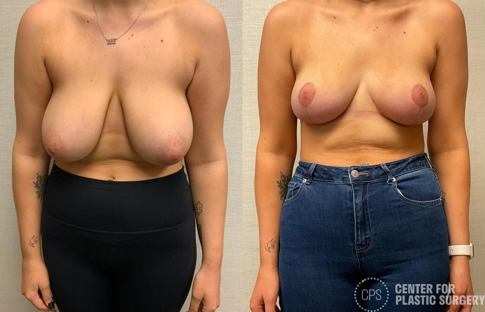 Breast Reduction Case 424 Before & After Front | Chevy Chase & Annandale, Washington D.C. Metropolitan Area | Center for Plastic Surgery
