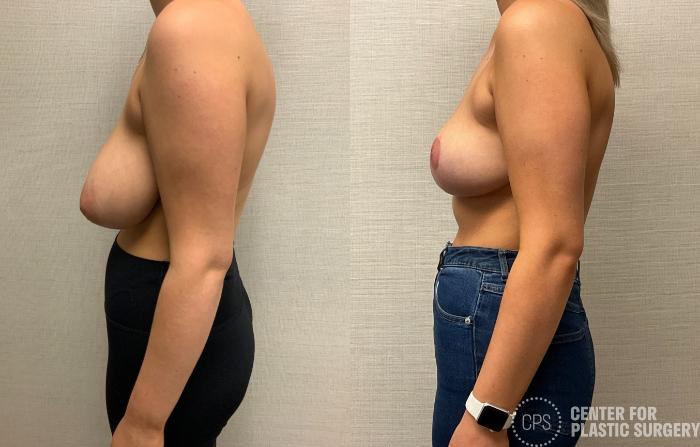 Breast Reduction Case 424 Before & After Left Side | Chevy Chase & Annandale, Washington D.C. Metropolitan Area | Center for Plastic Surgery
