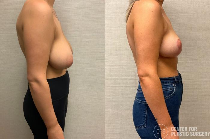 Breast Reduction Case 424 Before & After Right Side | Chevy Chase & Annandale, Washington D.C. Metropolitan Area | Center for Plastic Surgery