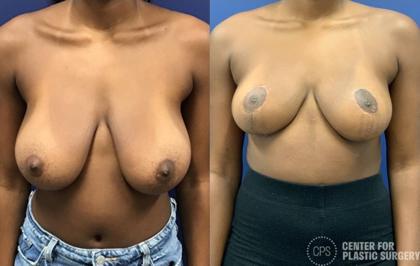 Breast Reduction Case 426 Before & After Front | Chevy Chase & Annandale, Washington D.C. Metropolitan Area | Center for Plastic Surgery