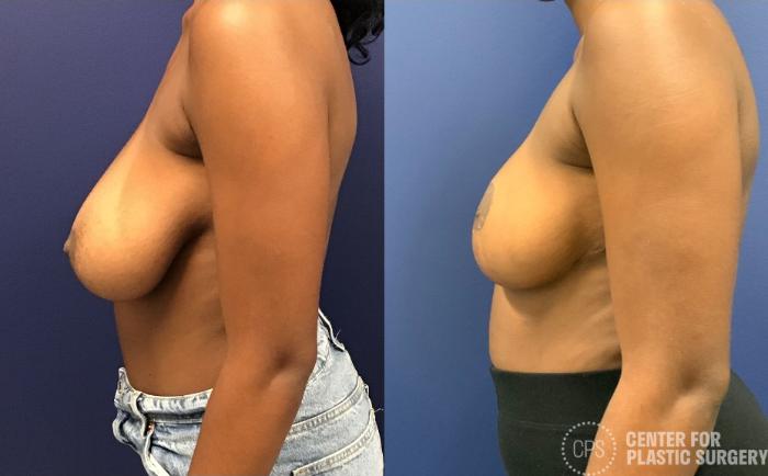Breast Reduction Case 426 Before & After Left Side | Chevy Chase & Annandale, Washington D.C. Metropolitan Area | Center for Plastic Surgery