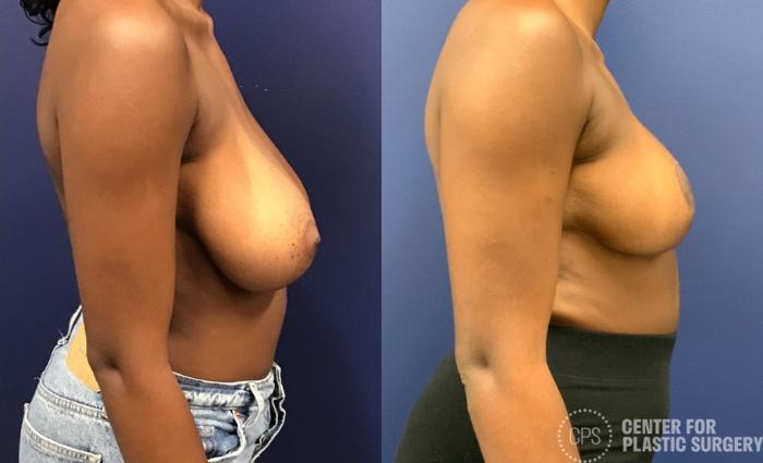 Breast Reduction Case 426 Before & After Right Side | Chevy Chase & Annandale, Washington D.C. Metropolitan Area | Center for Plastic Surgery