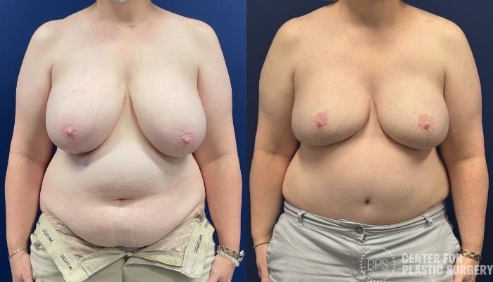 Breast Reconstruction Case 436 Before & After Front | Chevy Chase & Annandale, Washington D.C. Metropolitan Area | Center for Plastic Surgery