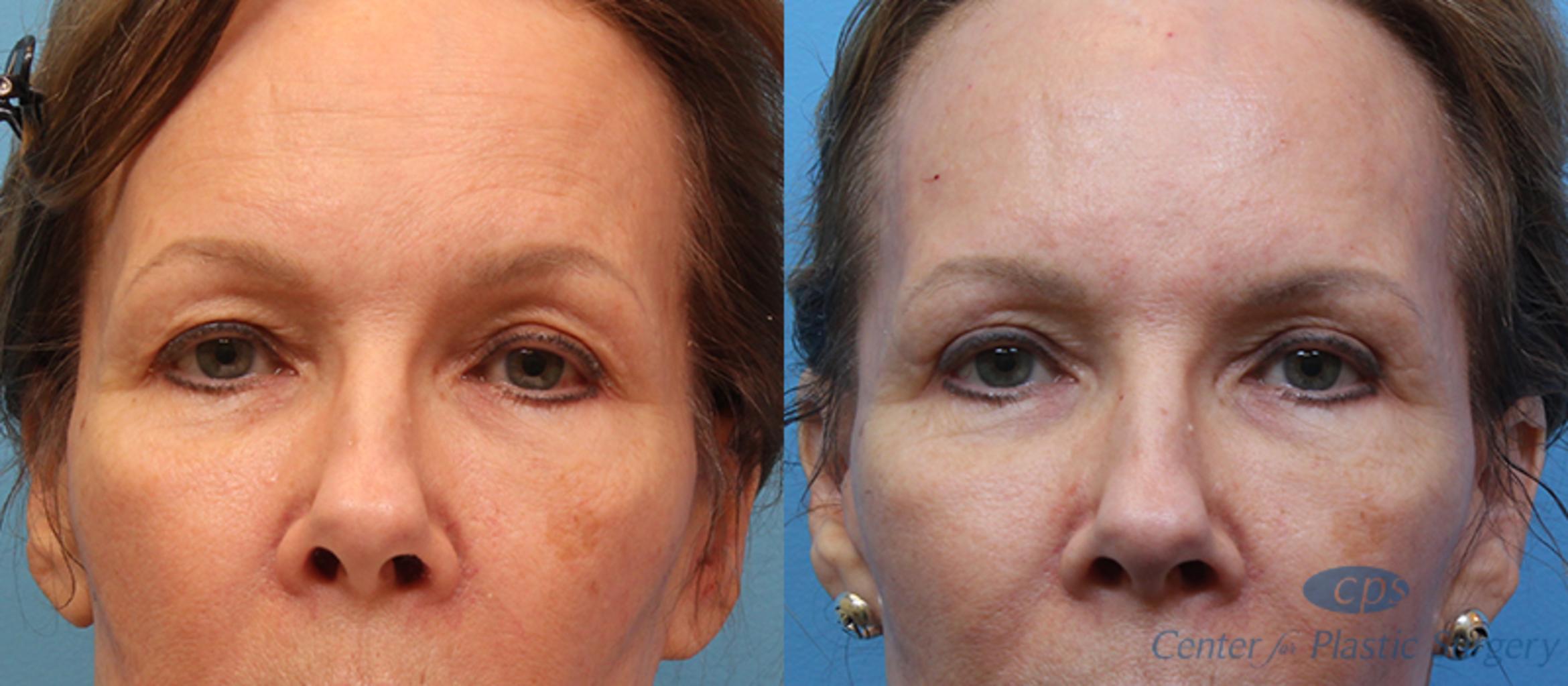 Eyelid Lift Before & After Photos Patient 14 Annandale, Virginia