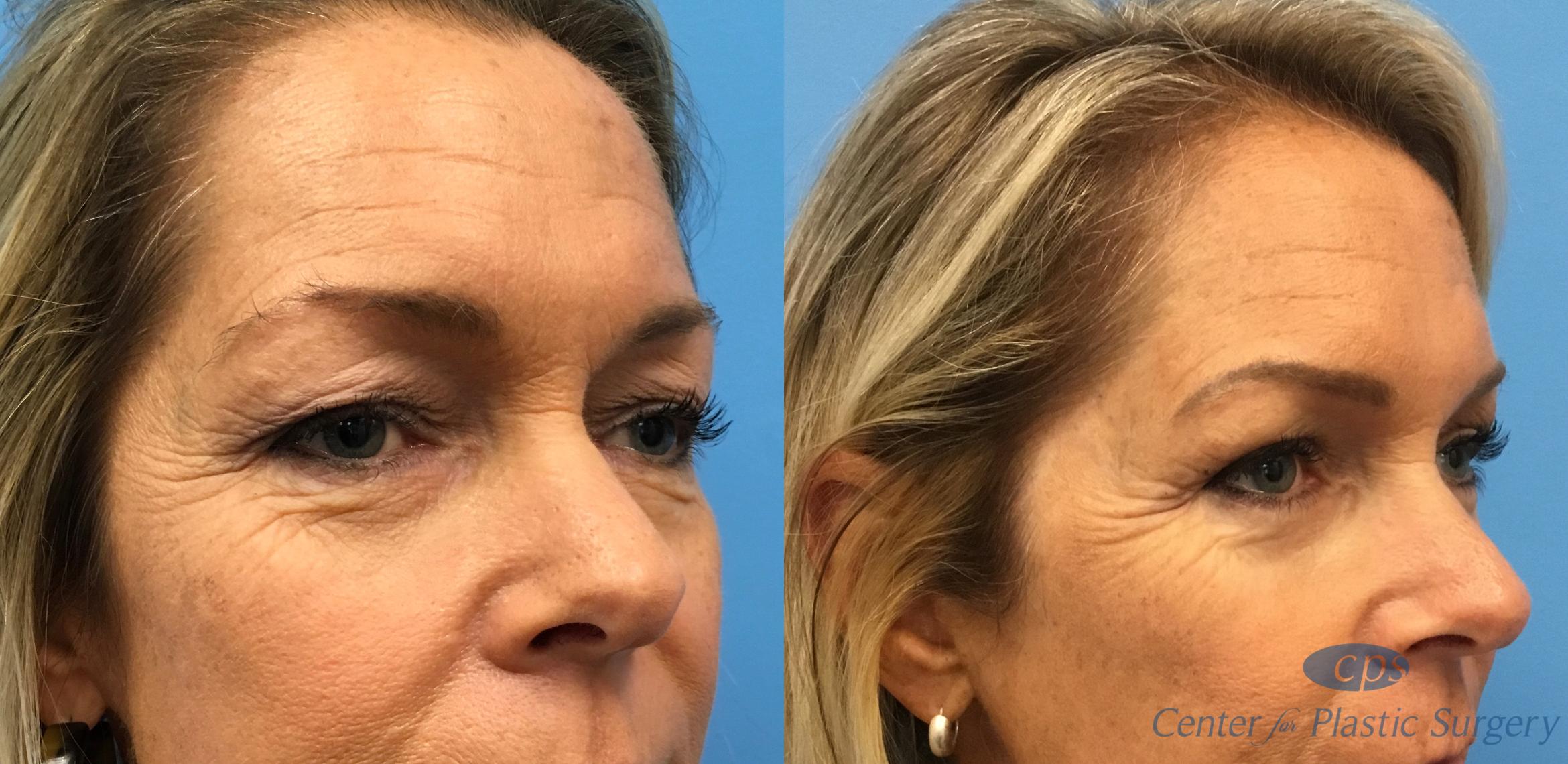 Eyelid Lift Before & After Photos Patient 147 Annandale, Virginia