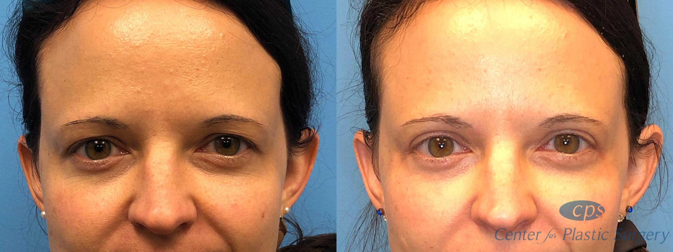Eyelid Surgery Case 169 Before & After Front | Annandale, Washington D.C. Metropolitan Area | Center for Plastic Surgery