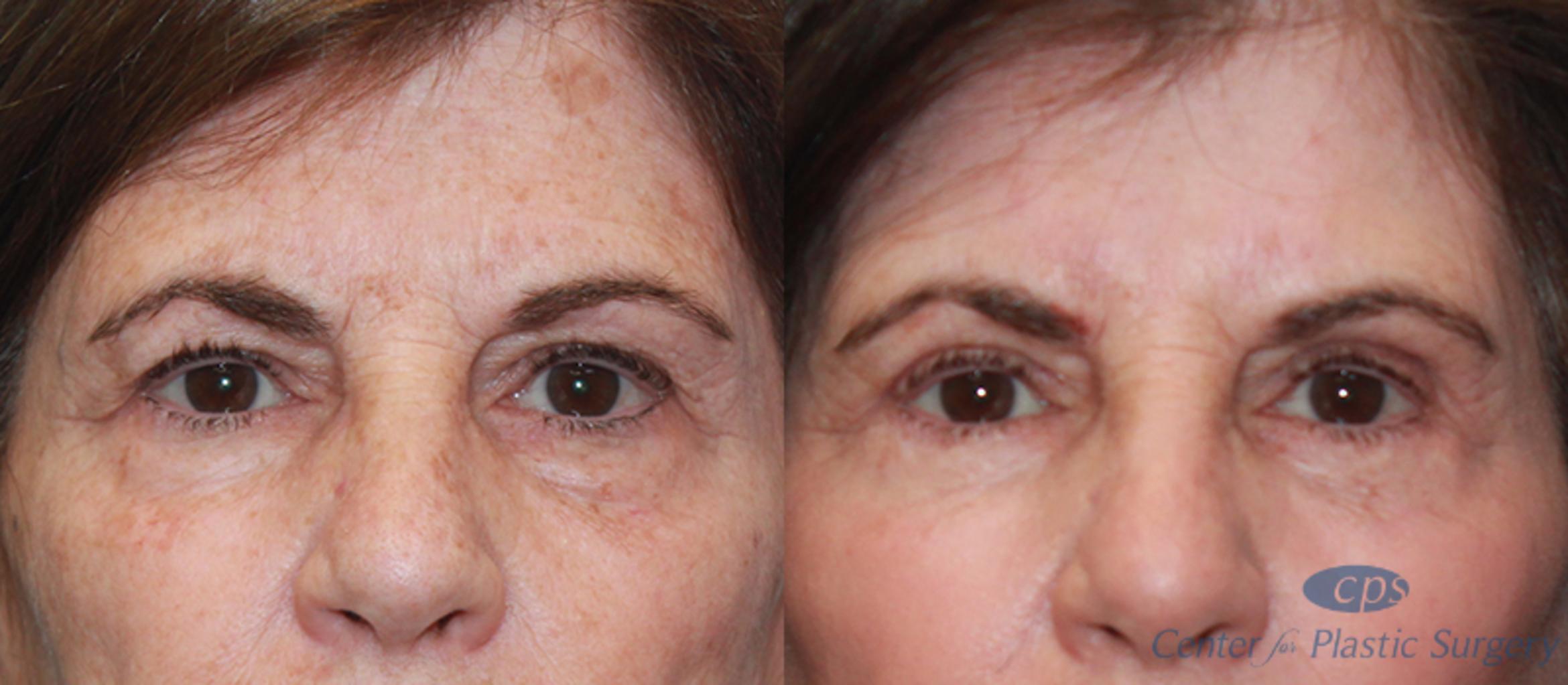 Eyelid Surgery Case 19 Before & After Front | Annandale, Washington D.C. Metropolitan Area | Center for Plastic Surgery