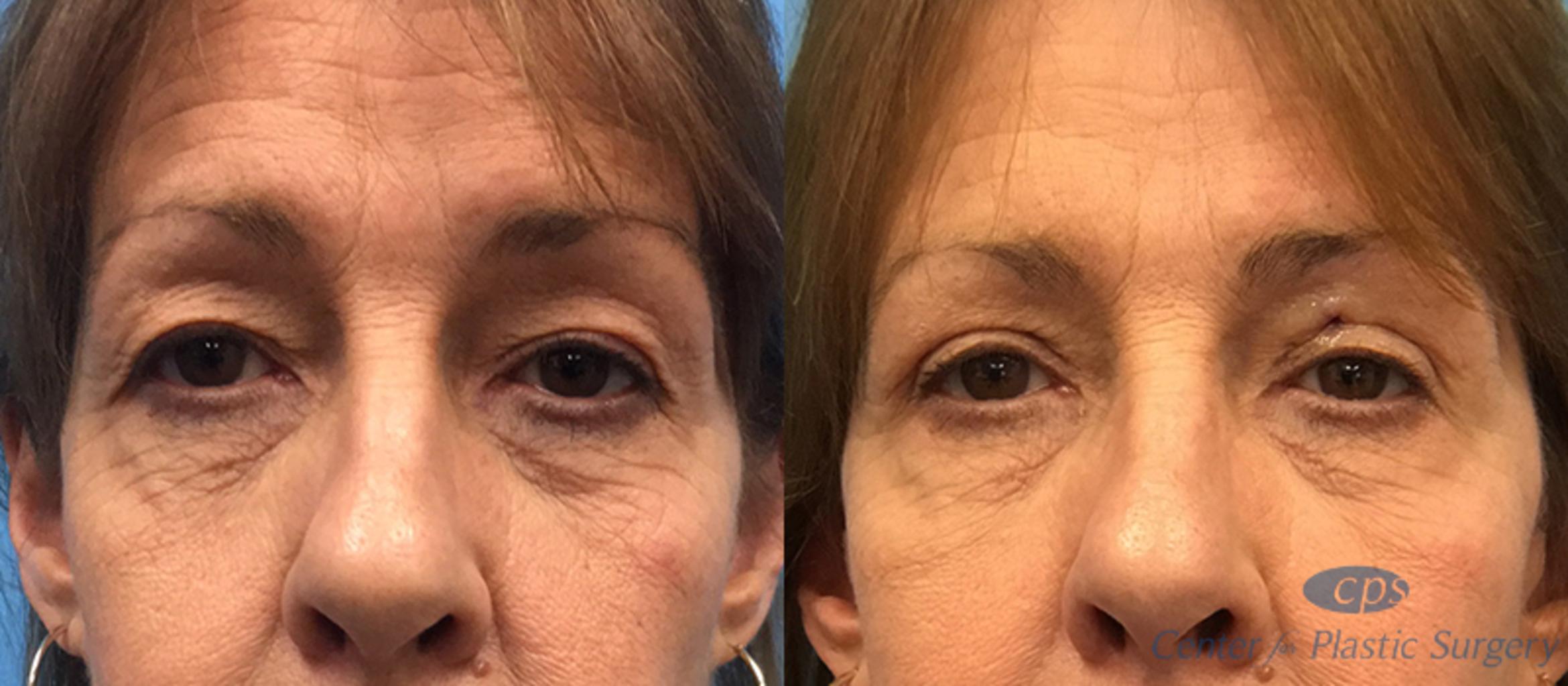 Eyelid Surgery Case 21 Before & After Front | Annandale, Washington D.C. Metropolitan Area | Center for Plastic Surgery