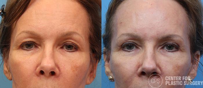 Eyelid Surgery Case 14 Before & After Front | Chevy Chase & Annandale, Washington D.C. Metropolitan Area | Center for Plastic Surgery