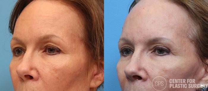 Eyelid Surgery Case 14 Before & After Left Oblique | Chevy Chase & Annandale, Washington D.C. Metropolitan Area | Center for Plastic Surgery