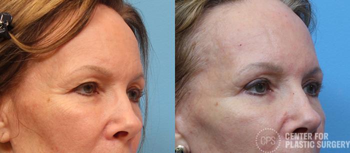 Eyelid Surgery Case 14 Before & After Right Oblique | Chevy Chase & Annandale, Washington D.C. Metropolitan Area | Center for Plastic Surgery