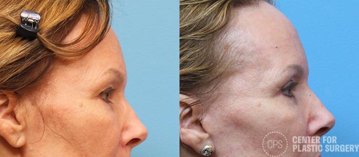 Eyelid Surgery Case 14 Before & After Right Side | Chevy Chase & Annandale, Washington D.C. Metropolitan Area | Center for Plastic Surgery
