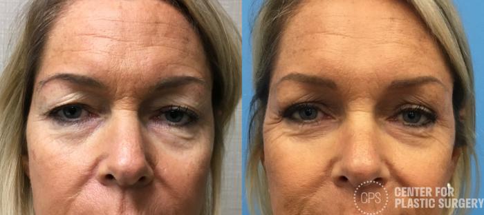 Eyelid Surgery Case 147 Before & After Front | Chevy Chase & Annandale, Washington D.C. Metropolitan Area | Center for Plastic Surgery