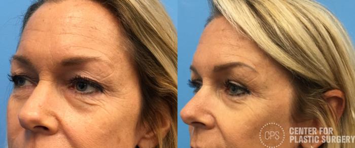 Eyelid Surgery Case 147 Before & After Left Oblique | Chevy Chase & Annandale, Washington D.C. Metropolitan Area | Center for Plastic Surgery