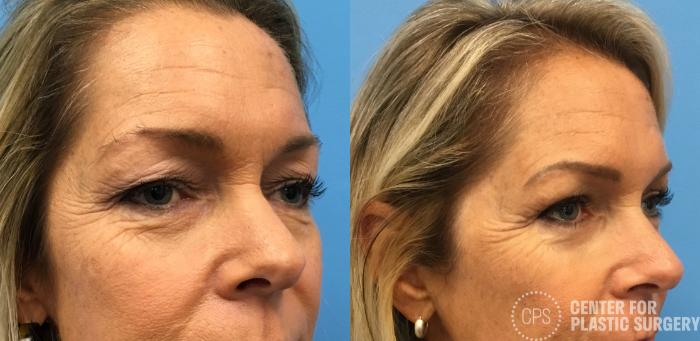 Eyelid Surgery Case 147 Before & After Right Oblique | Chevy Chase & Annandale, Washington D.C. Metropolitan Area | Center for Plastic Surgery