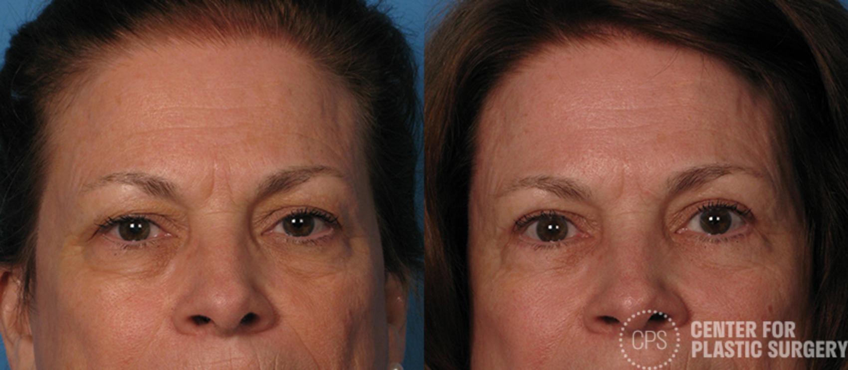 Eyelid Surgery Case 15 Before & After Front | Chevy Chase & Annandale, Washington D.C. Metropolitan Area | Center for Plastic Surgery