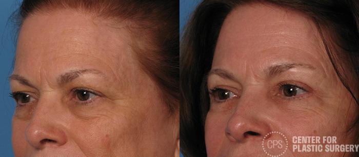 Eyelid Surgery Case 15 Before & After Left Oblique | Chevy Chase & Annandale, Washington D.C. Metropolitan Area | Center for Plastic Surgery