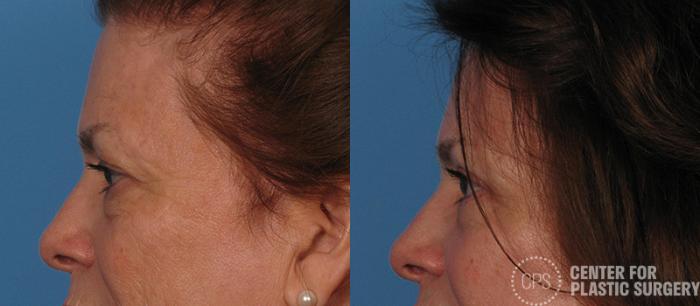 Eyelid Surgery Case 15 Before & After Left Side | Chevy Chase & Annandale, Washington D.C. Metropolitan Area | Center for Plastic Surgery