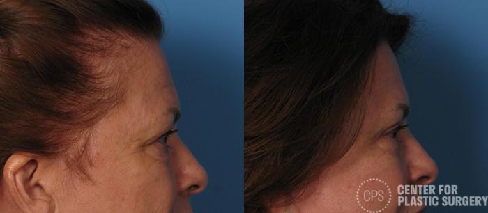 Eyelid Surgery Case 15 Before & After Right Side | Chevy Chase & Annandale, Washington D.C. Metropolitan Area | Center for Plastic Surgery