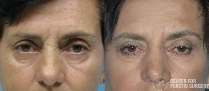 Eyelid Surgery Case 16 Before & After Front | Chevy Chase & Annandale, Washington D.C. Metropolitan Area | Center for Plastic Surgery