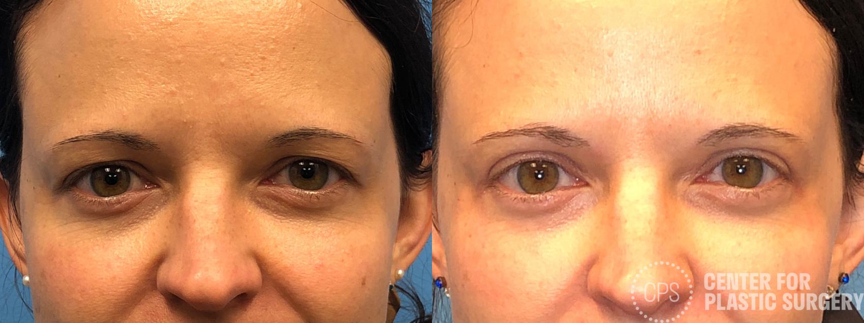 Eyelid Surgery Case 169 Before & After Front | Washington, DC, Washington D.C. Metropolitan Area | Center for Plastic Surgery