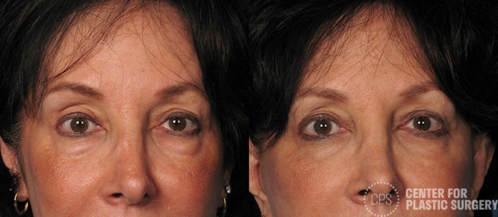 Eyelid Surgery Case 17 Before & After Front | Chevy Chase & Annandale, Washington D.C. Metropolitan Area | Center for Plastic Surgery