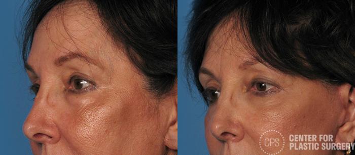 Eyelid Surgery Case 17 Before & After Left Side | Chevy Chase & Annandale, Washington D.C. Metropolitan Area | Center for Plastic Surgery