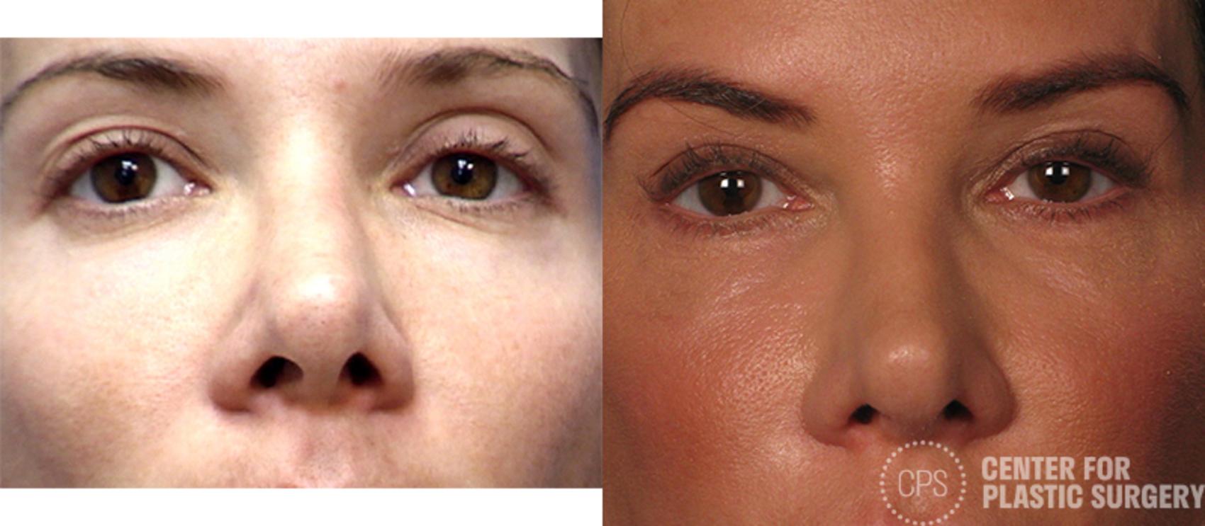 Eyelid Surgery Case 18 Before & After Front | Annandale, Washington D.C. Metropolitan Area | Center for Plastic Surgery