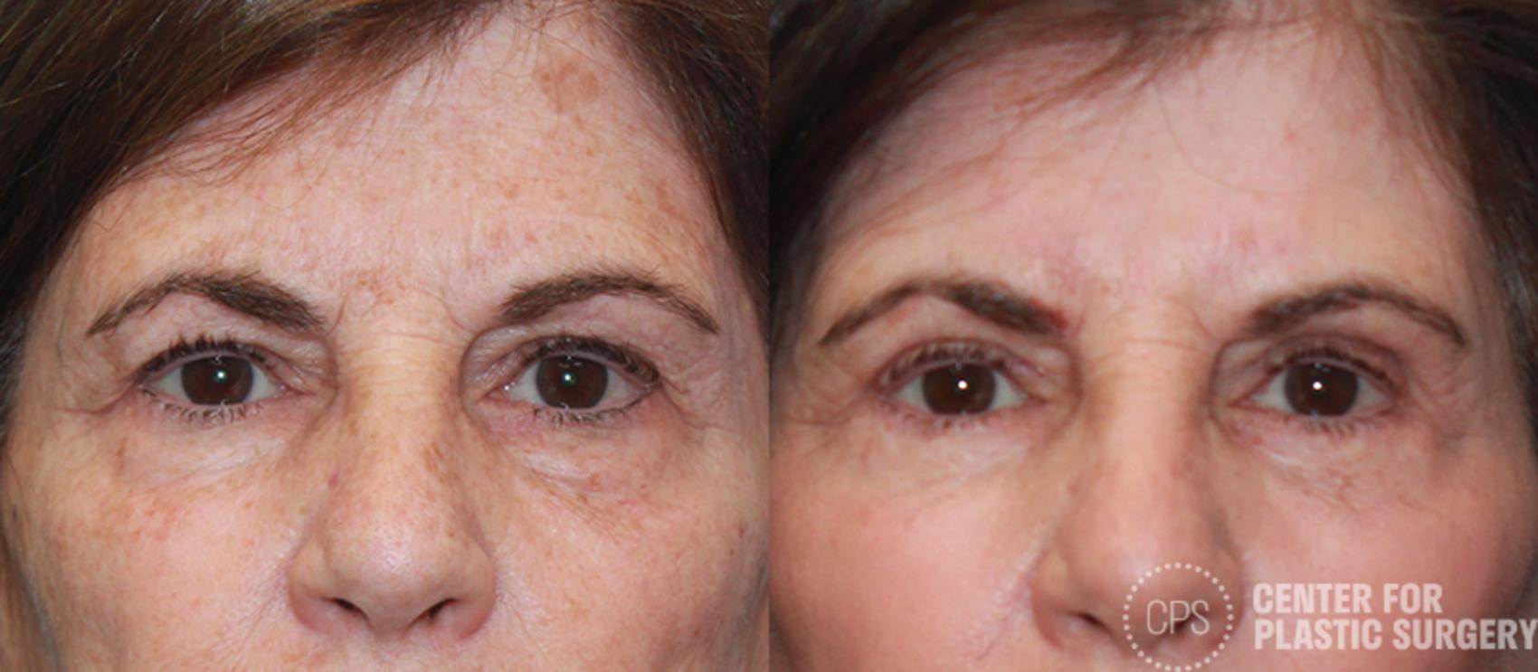 Eyelid Surgery Case 19 Before & After Front | Chevy Chase & Annandale, Washington D.C. Metropolitan Area | Center for Plastic Surgery
