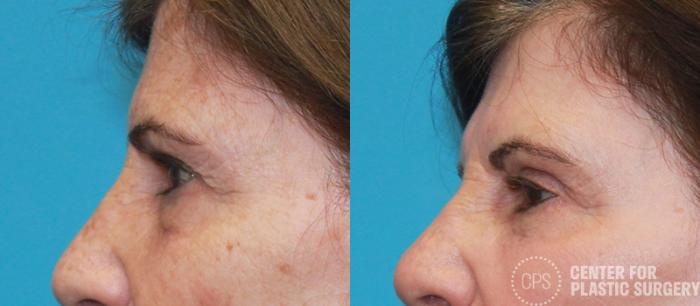 Eyelid Surgery Case 19 Before & After Left Side | Chevy Chase & Annandale, Washington D.C. Metropolitan Area | Center for Plastic Surgery