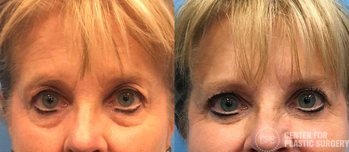 Eyelid Surgery Case 20 Before & After Front | Chevy Chase & Annandale, Washington D.C. Metropolitan Area | Center for Plastic Surgery