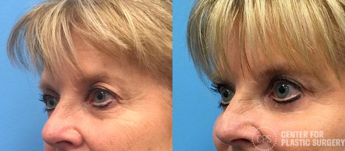 Eyelid Surgery Case 20 Before & After Left Oblique | Chevy Chase & Annandale, Washington D.C. Metropolitan Area | Center for Plastic Surgery